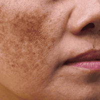 Melasma