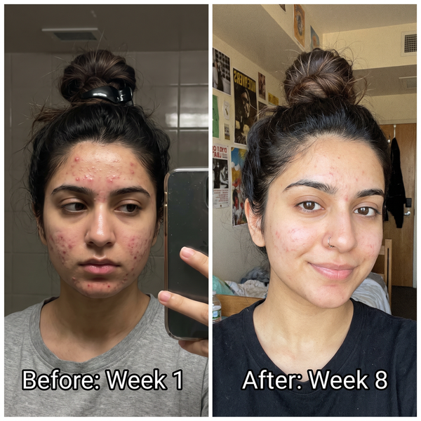 Acne before and after – pimples and redness cleared with Charisma Acne Clear Control Plan
