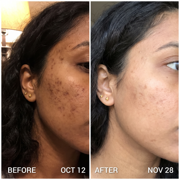 Dark spots before and after – post-acne marks lightened with Charisma Dark Spot Removal Plan