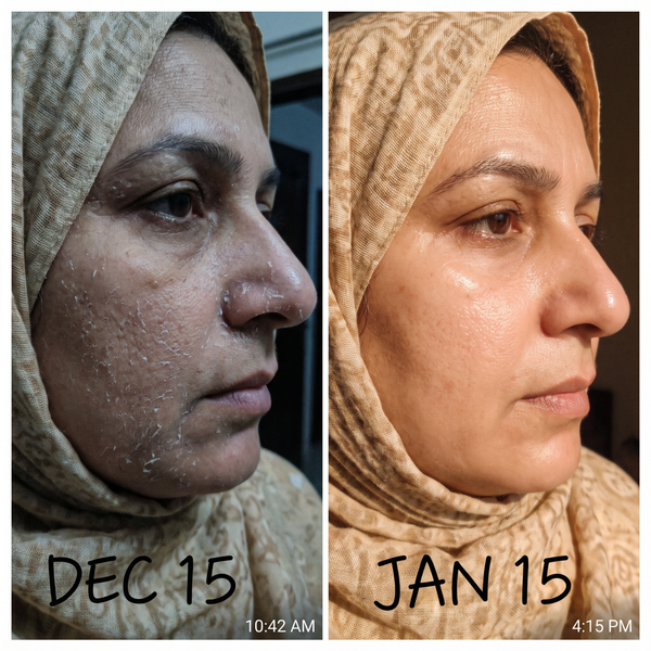 Dry skin before and after – flaky dry patches hydrated with Charisma Deep Moisture Repair Plan