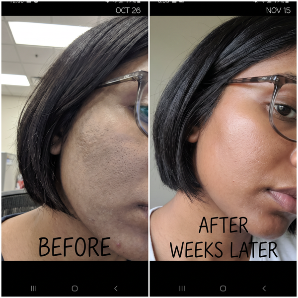 Dullness before and after – ashy dull skin turned radiant with Charisma Glow Revival Dullness Plan