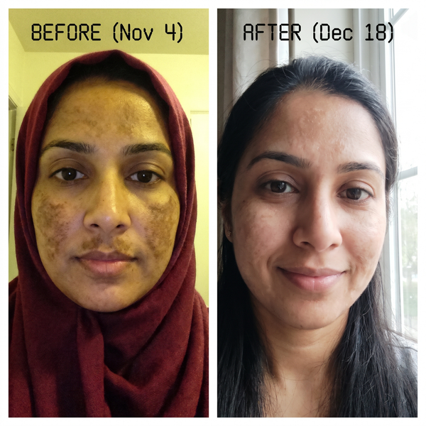Melasma before and after – brown patches on cheeks faded with Charisma Melasma Treatment Plan